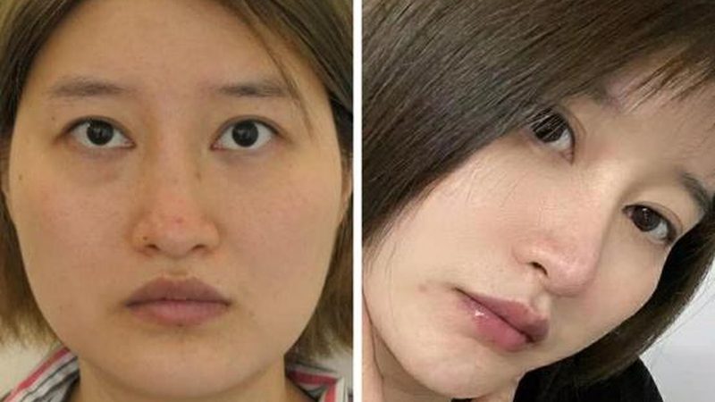 隆胸手术风险解析：揭秘真实风险与应对策略