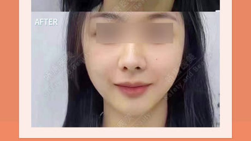 埋线提升法令纹，术后护理攻略揭秘