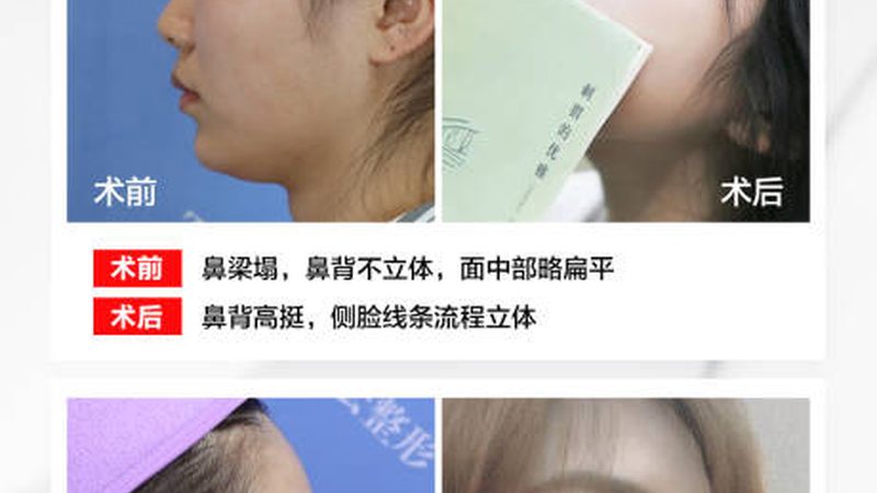 小标题：双眼皮手术，了解这些是关键