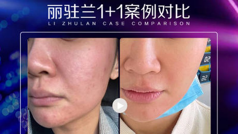 沈阳韩式双眼皮：效果持久的关键因素