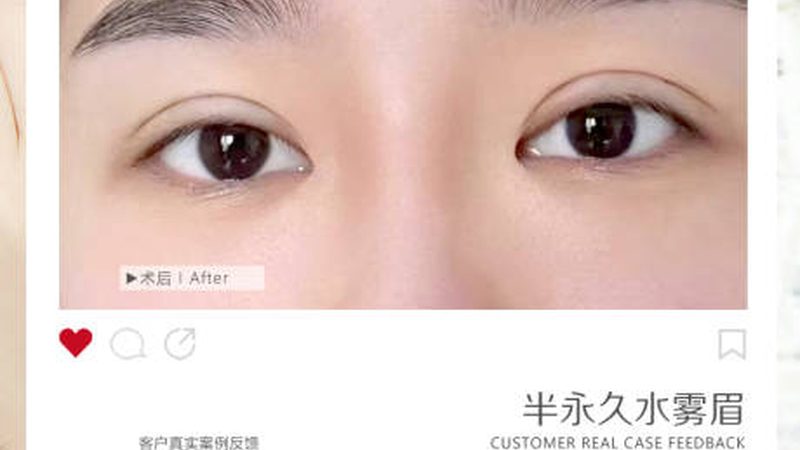 男士做埋线提升前，这几步准备别跳过