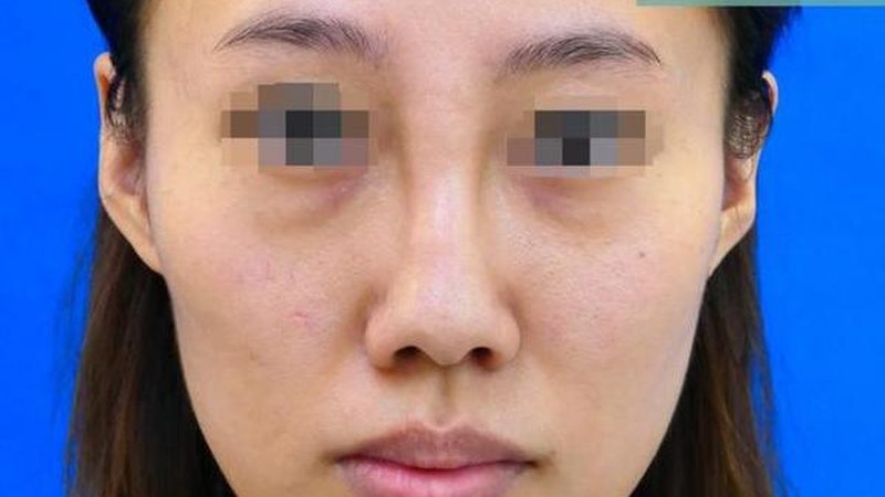 广州光子嫩肤与超光子：揭秘团购价格背后的差异